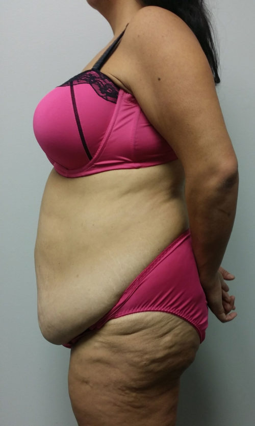 Tummy tuck (Abdominoplasty)