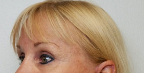 Brow Lift/Forehead Rejuvenation Case 10462 After Photo Brow Lift/Forehead Rejuvenation