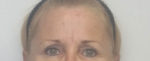 Brow Lift/Forehead Rejuvenation