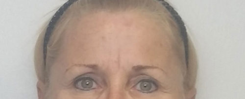 Brow Lift/Forehead Rejuvenation Case 10462 Before Photo Brow Lift/Forehead Rejuvenation