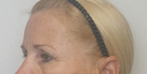 Brow Lift/Forehead Rejuvenation Case 10462 Before Photo Brow Lift/Forehead Rejuvenation