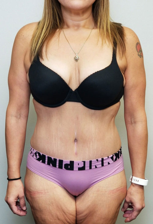 Tummy tuck (Abdominoplasty) Case 10602 After Photo Tummy tuck (Abdominoplasty)