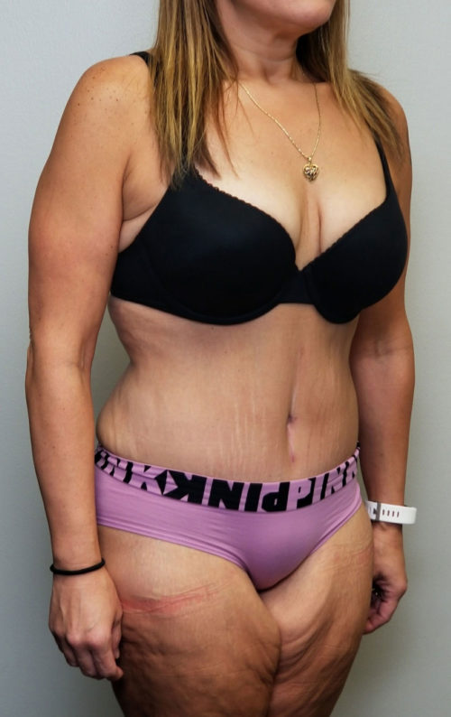 Tummy tuck (Abdominoplasty) Case 10602 After Photo Tummy tuck (Abdominoplasty)