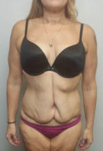 Tummy tuck (Abdominoplasty)