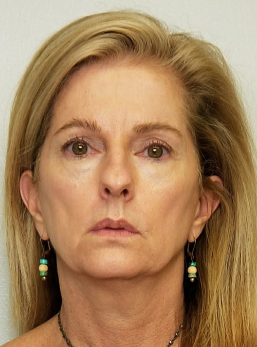 Brow Lift/Forehead Rejuvenation Case 10467 Before Photo Brow Lift/Forehead Rejuvenation