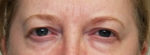 Eyelid Surgery