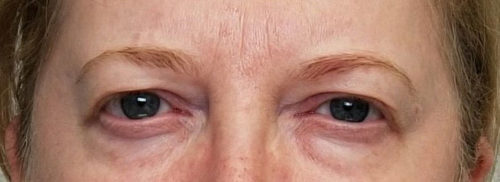 Eyelid Surgery Case 10500 Before Photo Eyelid Surgery