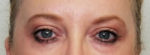 Eyelid Surgery