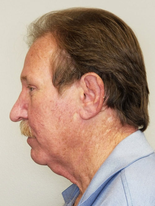 Rhinoplasty/Nose Reshaping Case 10549 After Photo Rhinoplasty/Nose Reshaping