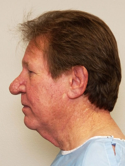 Rhinoplasty/Nose Reshaping Case 10549 Before Photo Rhinoplasty/Nose Reshaping