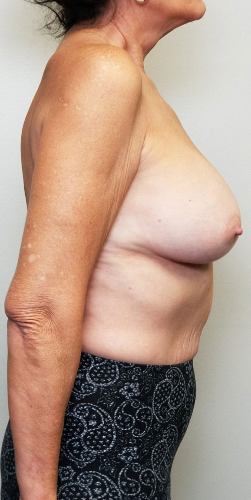 Breast Augmentation Case 10392 After Photo Breast Augmentation