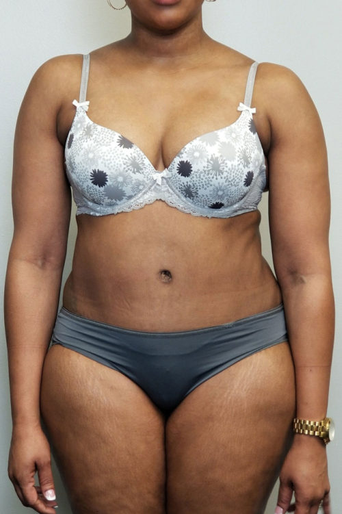 Tummy tuck (Abdominoplasty) Case 10609 After Photo Tummy tuck (Abdominoplasty)