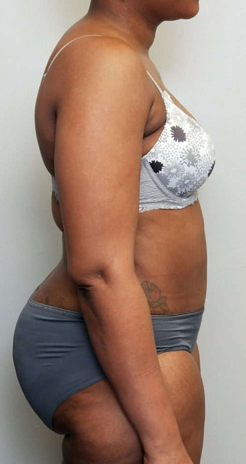 Tummy tuck (Abdominoplasty)