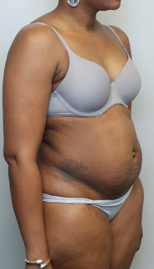 Tummy tuck (Abdominoplasty) Case 10609 Before Photo Tummy tuck (Abdominoplasty)