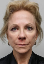 Brow Lift/Forehead Rejuvenation