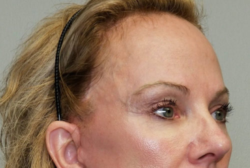 Brow Lift/Forehead Rejuvenation Case 10475 After Photo Brow Lift/Forehead Rejuvenation