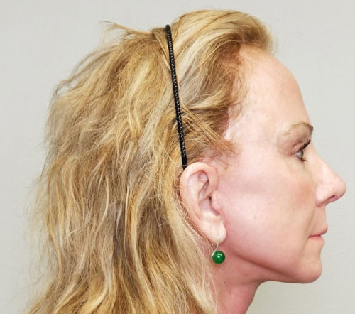 Brow Lift/Forehead Rejuvenation Case 10475 After Photo Brow Lift/Forehead Rejuvenation