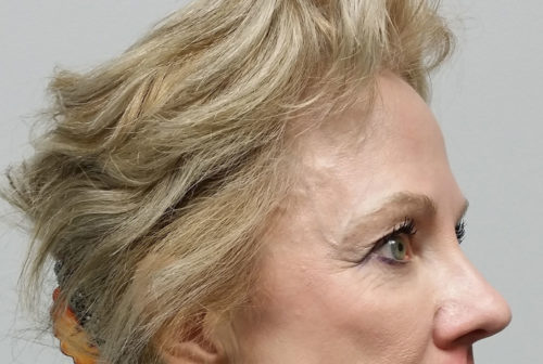 Brow Lift/Forehead Rejuvenation Case 10475 Before Photo Brow Lift/Forehead Rejuvenation