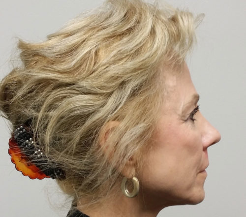 Brow Lift/Forehead Rejuvenation Case 10475 Before Photo Brow Lift/Forehead Rejuvenation