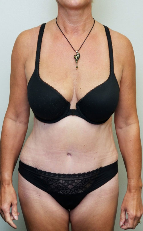 Tummy tuck (Abdominoplasty) Case 10616 After Photo Tummy tuck (Abdominoplasty)