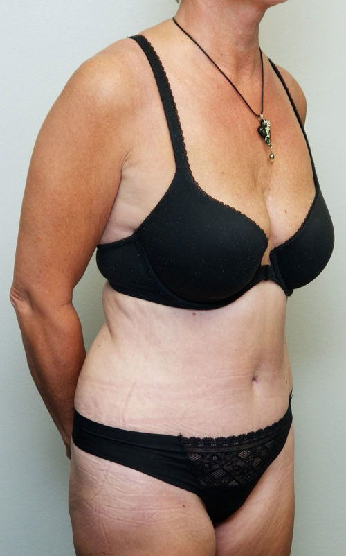 Tummy tuck (Abdominoplasty)