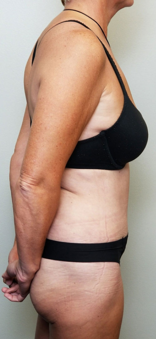 Tummy tuck (Abdominoplasty)