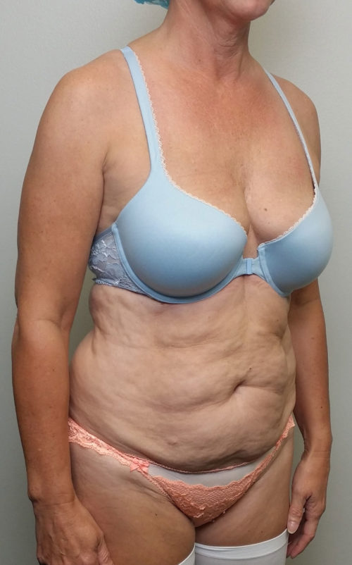 Tummy tuck (Abdominoplasty)