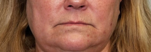 Valentine lip lift Case 10556 Before Photo Valentine lip lift