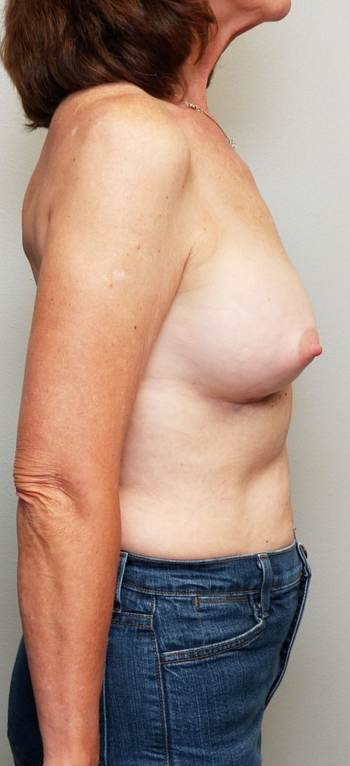 Breast Augmentation Case 10399 After Photo Breast Augmentation