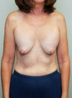 Breast Augmentation