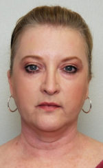 Brow Lift/Forehead Rejuvenation