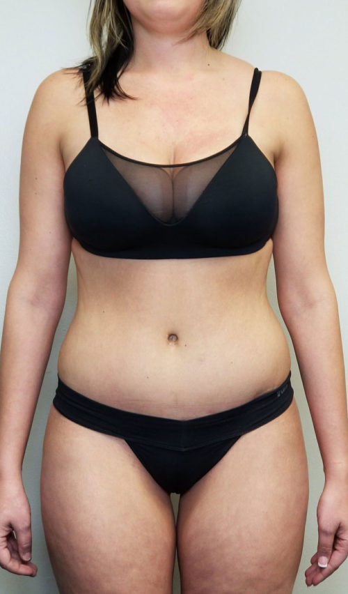 Tummy tuck (Abdominoplasty)