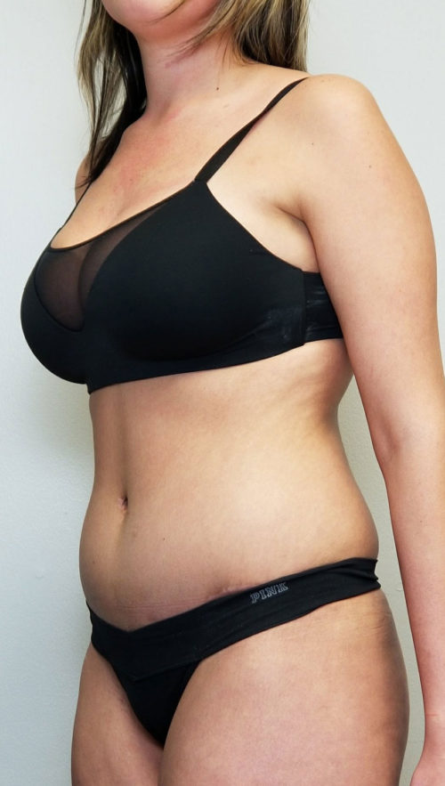 Tummy tuck (Abdominoplasty)