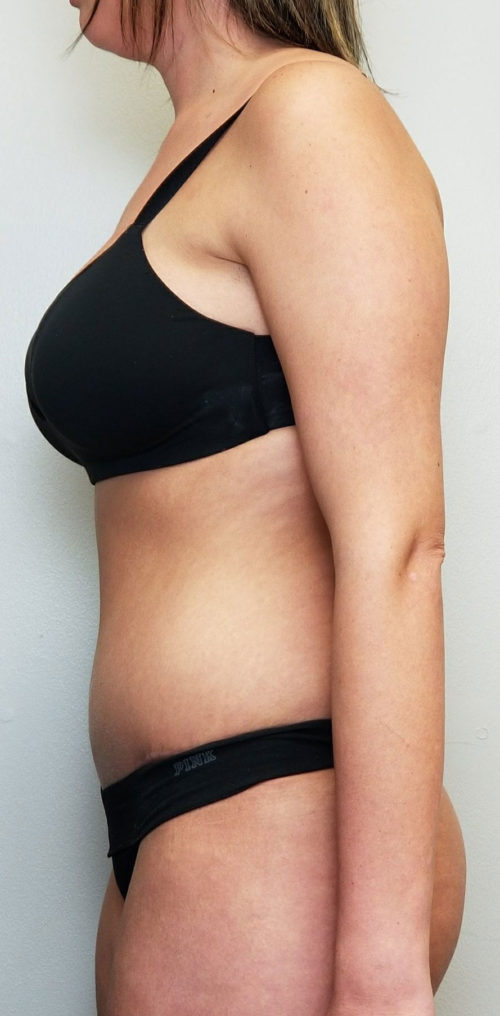 Tummy tuck (Abdominoplasty)