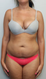 Tummy tuck (Abdominoplasty)