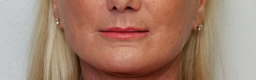 Valentine lip lift Case 10559 After Photo Valentine lip lift