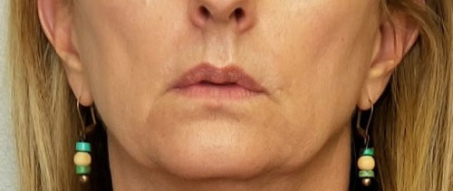 Valentine lip lift Case 10564 Before Photo Valentine lip lift