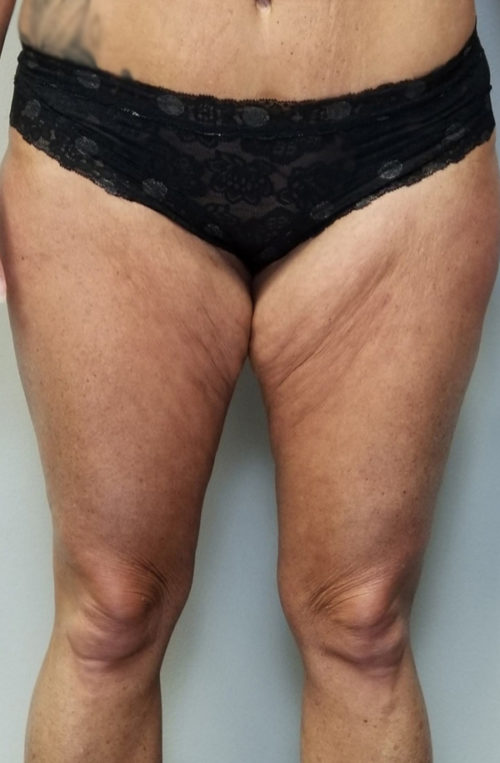 Thigh Lift Case 10804 Before Photo Thigh Lift