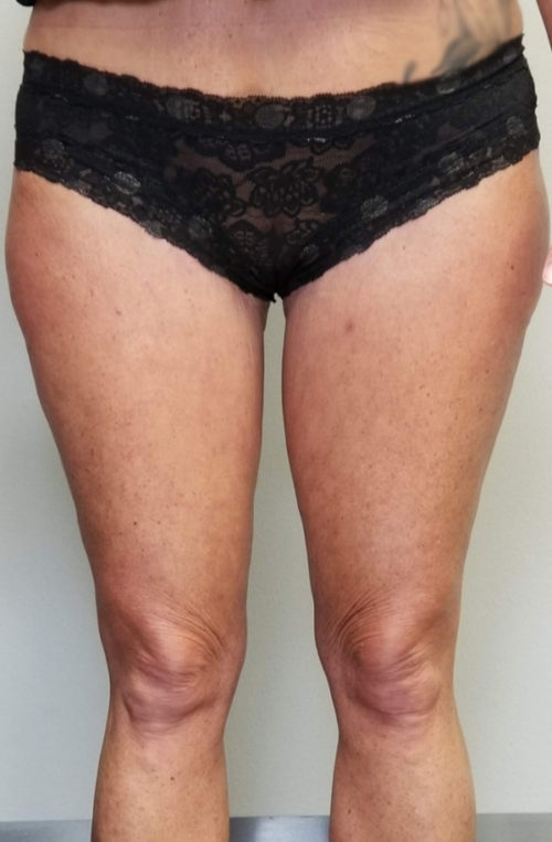 Thigh Lift Case 10804 After Photo Thigh Lift