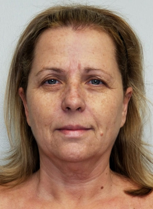 Brow Lift/Forehead Rejuvenation Case 10805 Before Photo Brow Lift/Forehead Rejuvenation