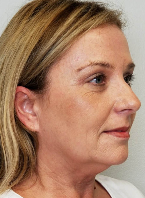 Brow Lift/Forehead Rejuvenation Case 10805 After Photo Brow Lift/Forehead Rejuvenation