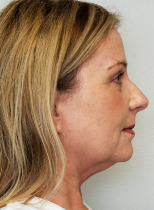 Brow Lift/Forehead Rejuvenation Case 10805 After Photo Brow Lift/Forehead Rejuvenation