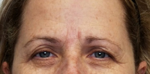 Eyelid Surgery Case 10807 Before Photo Eyelid Surgery