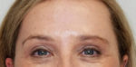 Eyelid Surgery