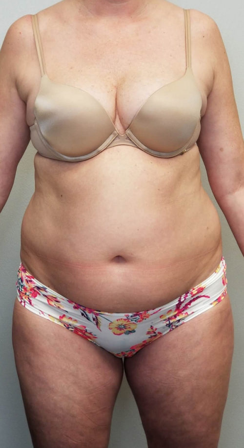 Liposuction Case 10808 Before Photo Liposuction