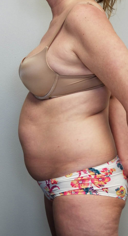 Liposuction Case 10808 Before Photo Liposuction