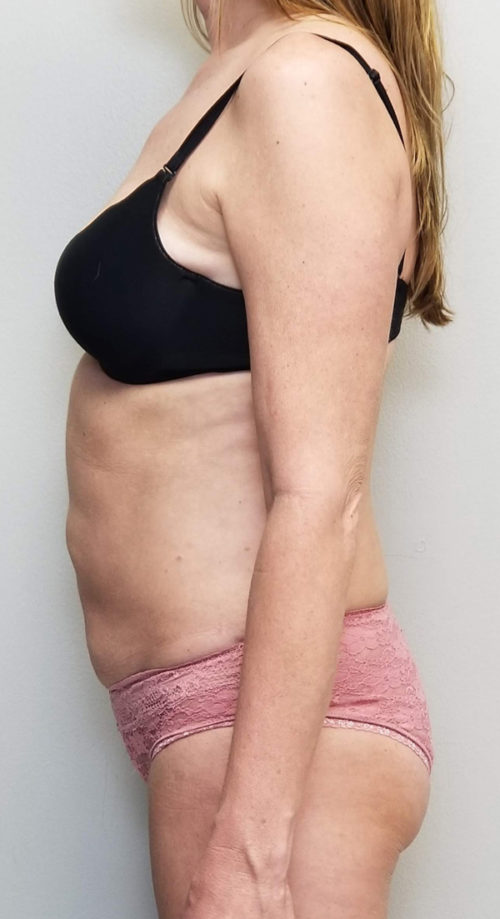Liposuction Case 10808 After Photo Liposuction