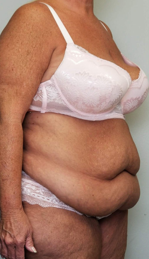 Tummy tuck (Abdominoplasty) Case 10809 Before Photo Tummy tuck (Abdominoplasty)