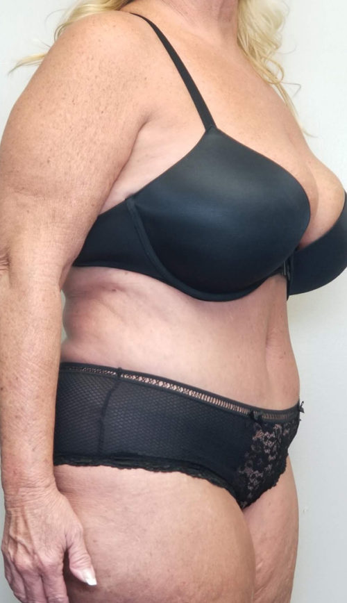 Tummy tuck (Abdominoplasty) Case 10809 After Photo Tummy tuck (Abdominoplasty)