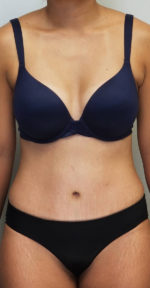 Tummy tuck (Abdominoplasty)